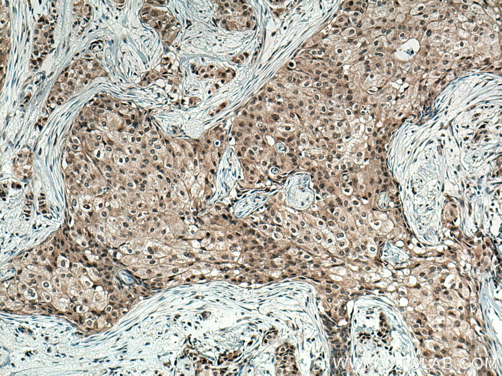 Immunohistochemistry (IHC) staining of human breast cancer tissue using WBP11 Polyclonal antibody (10316-1-AP)