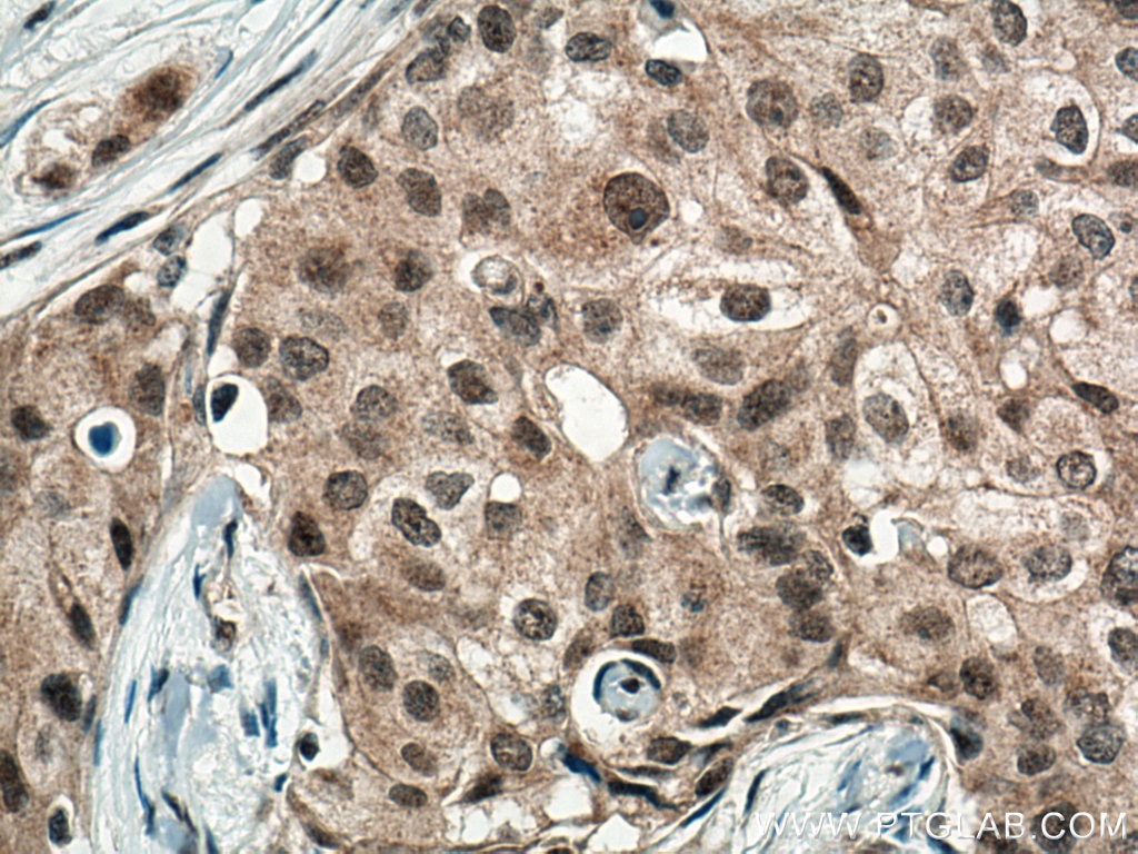 Immunohistochemistry (IHC) staining of human breast cancer tissue using WBP11 Polyclonal antibody (10316-1-AP)