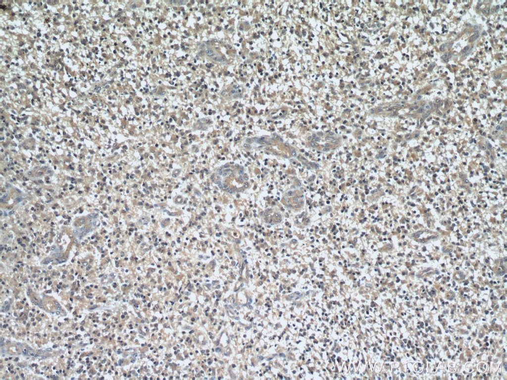 Immunohistochemistry (IHC) staining of human gliomas tissue using WBP2 Polyclonal antibody (12030-1-AP)