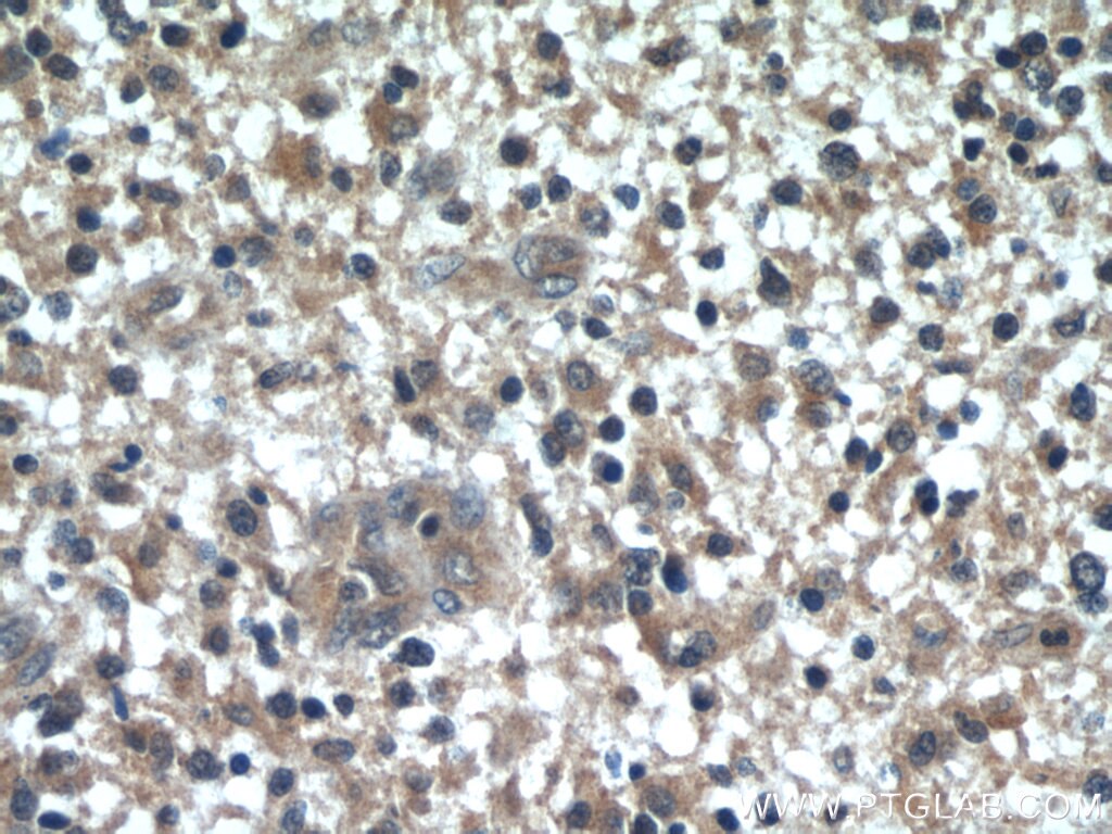 Immunohistochemistry (IHC) staining of human gliomas tissue using WBP2 Polyclonal antibody (12030-1-AP)