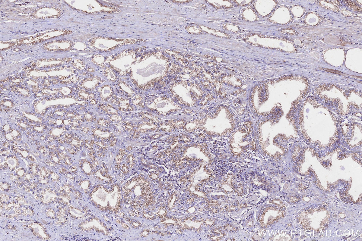 Immunohistochemistry (IHC) staining of human prostate cancer tissue using WBSCR17 Polyclonal antibody (21280-1-AP)
