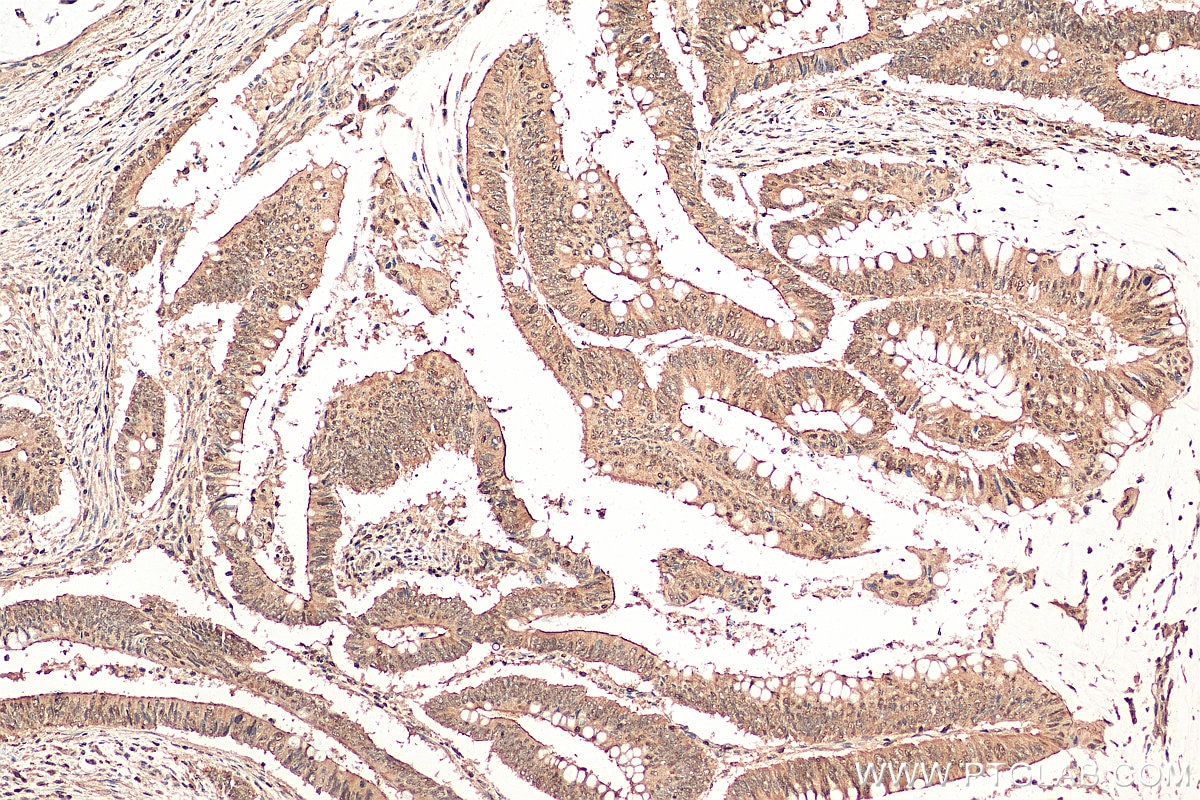 Immunohistochemistry (IHC) staining of human colon cancer tissue using WBSCR22 Polyclonal antibody (28192-1-AP)