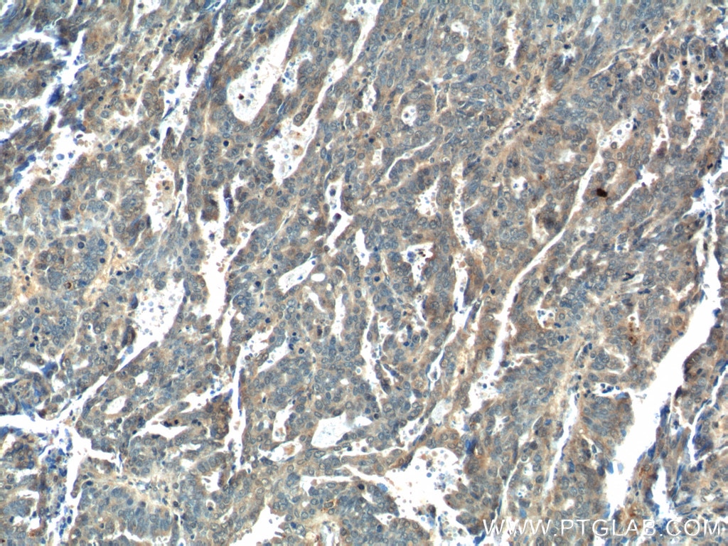 Immunohistochemistry (IHC) staining of human ovary tumor tissue using WDFY3 / ALFY Polyclonal antibody (25134-1-AP)