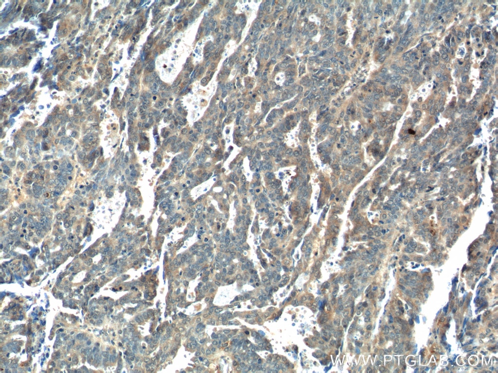 IHC staining of human ovary tumor using 25134-1-AP