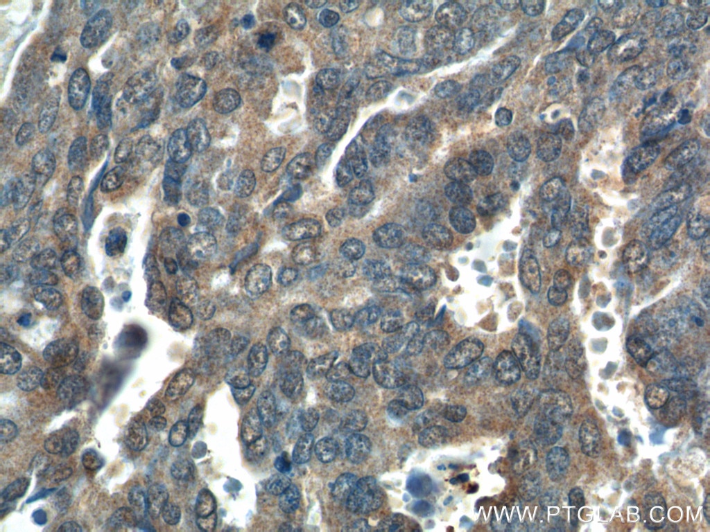 IHC staining of human ovary tumor using 25134-1-AP