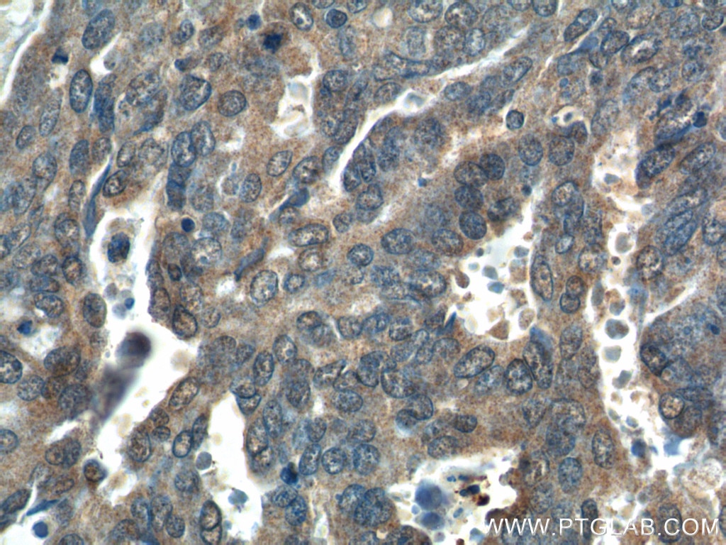 Immunohistochemistry (IHC) staining of human ovary tumor tissue using WDFY3 / ALFY Polyclonal antibody (25134-1-AP)