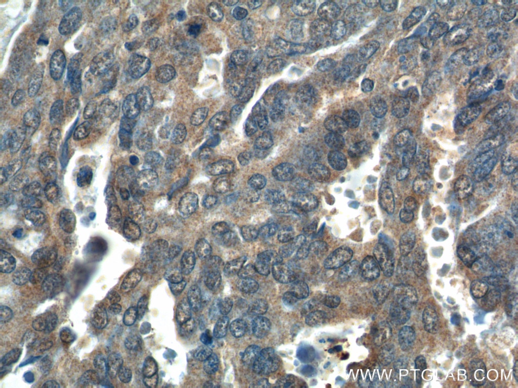 Immunohistochemistry (IHC) staining of human ovary tumor tissue using WDFY3 / ALFY Polyclonal antibody (25134-1-AP)