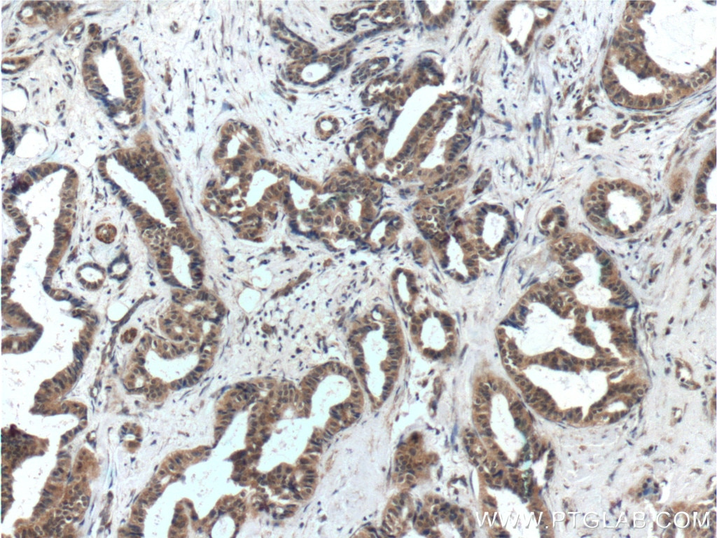 Immunohistochemistry (IHC) staining of human breast cancer tissue using WDFY3 / ALFY Polyclonal antibody (25134-1-AP)