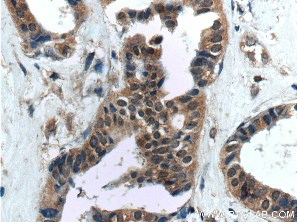 Immunohistochemistry (IHC) staining of human breast cancer tissue using WDFY3 / ALFY Polyclonal antibody (25134-1-AP)