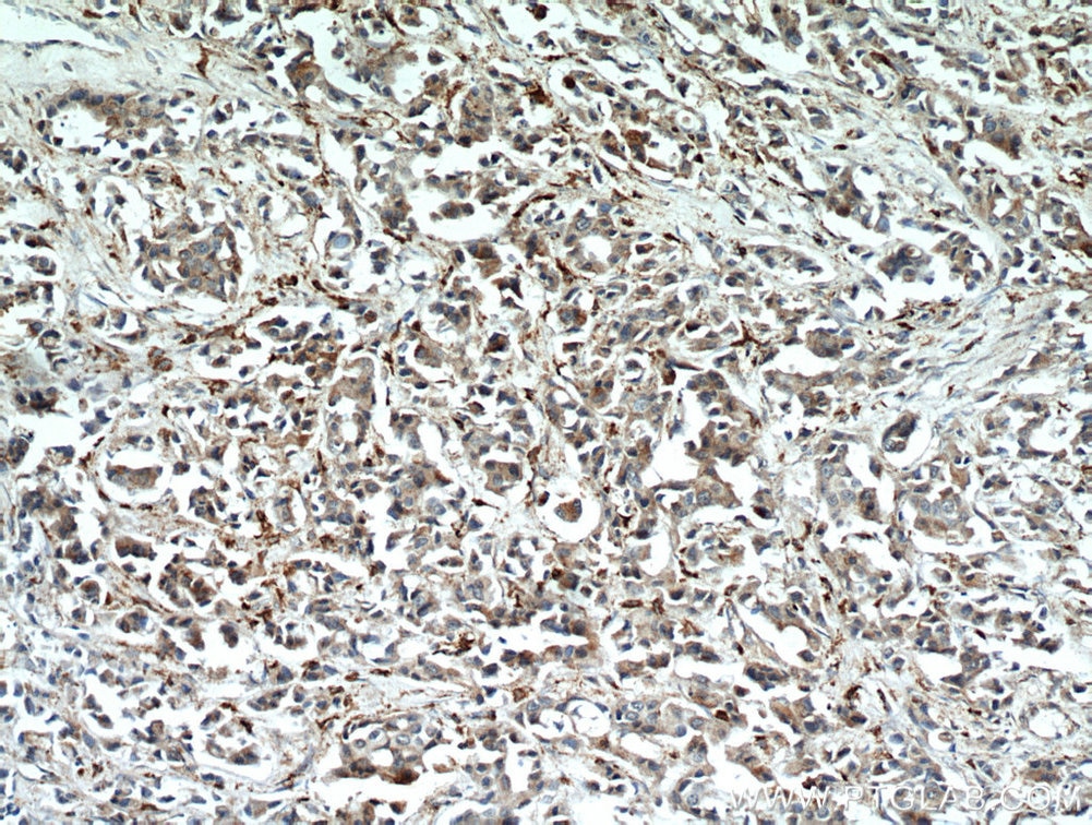 Immunohistochemistry (IHC) staining of human breast cancer tissue using WDFY3 Polyclonal antibody (55009-1-AP)