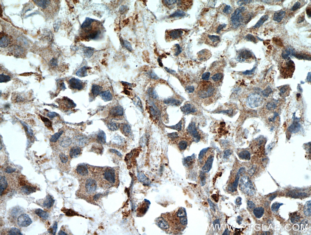 IHC staining of human breast cancer using 55009-1-AP
