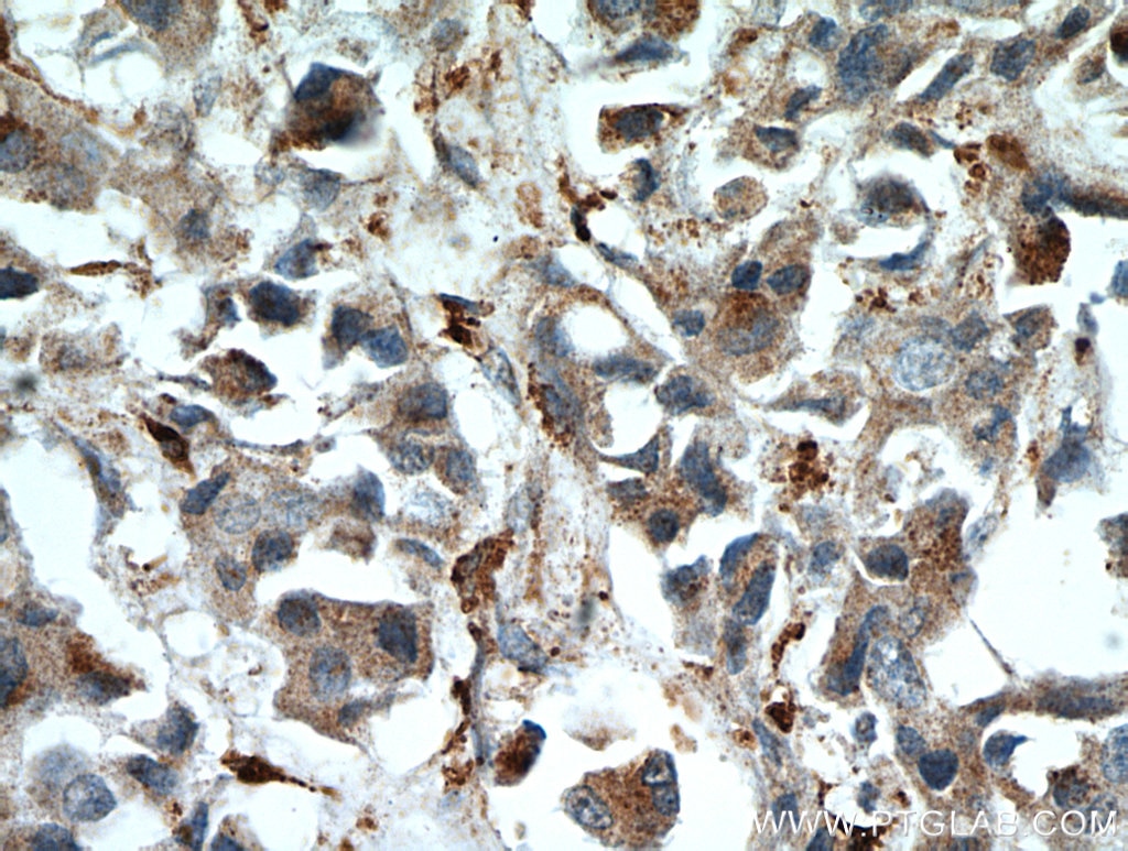 Immunohistochemistry (IHC) staining of human breast cancer tissue using WDFY3 Polyclonal antibody (55009-1-AP)