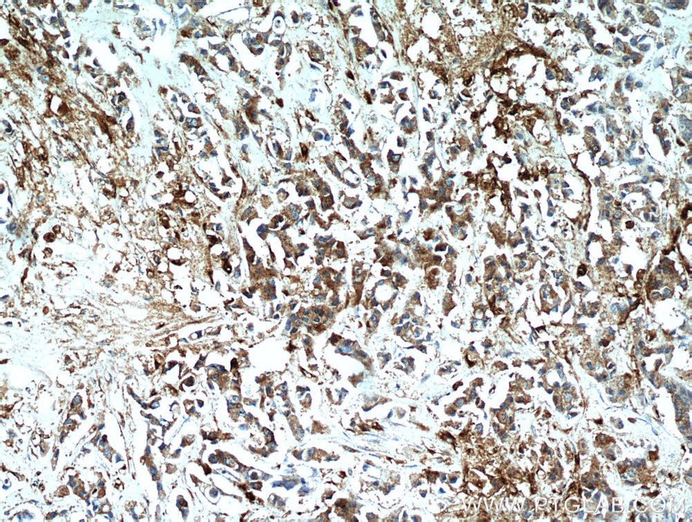 Immunohistochemistry (IHC) staining of human breast cancer tissue using WDFY3 Polyclonal antibody (55009-1-AP)