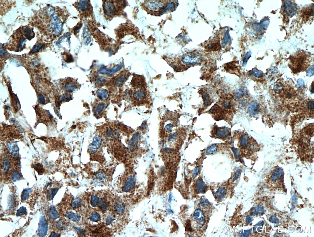 Immunohistochemistry (IHC) staining of human breast cancer tissue using WDFY3 Polyclonal antibody (55009-1-AP)