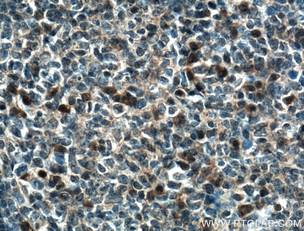 Immunohistochemistry (IHC) staining of human tonsillitis tissue using WDFY4 Polyclonal antibody (17558-1-AP)
