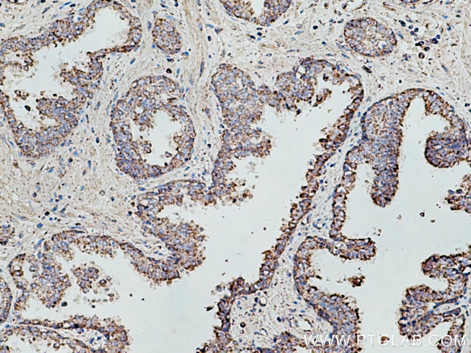 Immunohistochemistry (IHC) staining of human prostate cancer tissue using WDFY4 Polyclonal antibody (17558-1-AP)