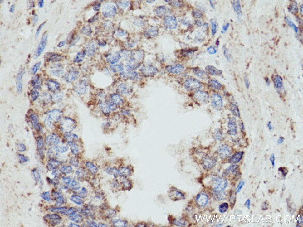 Immunohistochemistry (IHC) staining of human prostate cancer tissue using WDFY4 Polyclonal antibody (17558-1-AP)