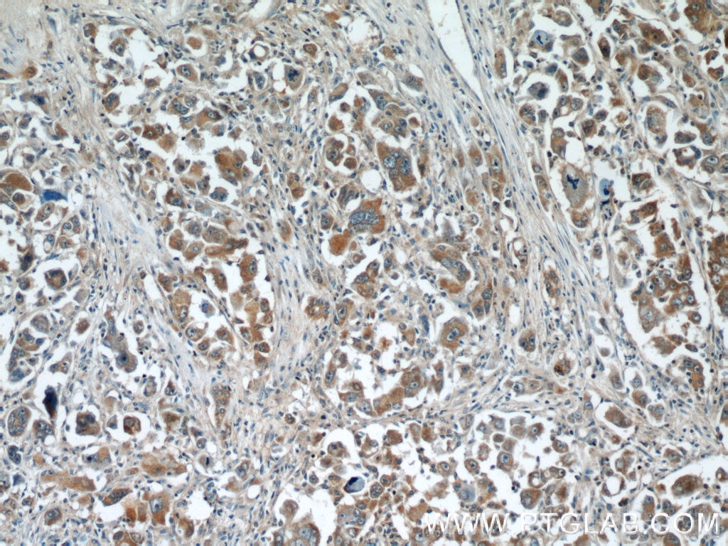 Immunohistochemistry (IHC) staining of human liver cancer tissue using WDR16 Polyclonal antibody (12644-1-AP)