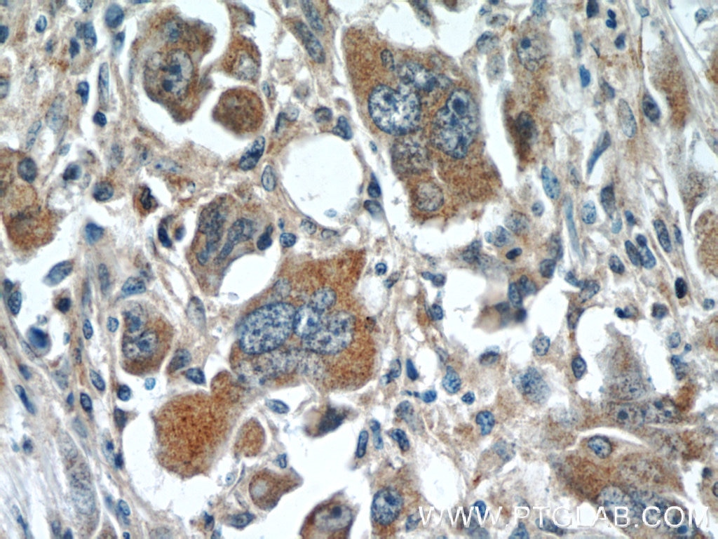 Immunohistochemistry (IHC) staining of human liver cancer tissue using WDR16 Polyclonal antibody (12644-1-AP)