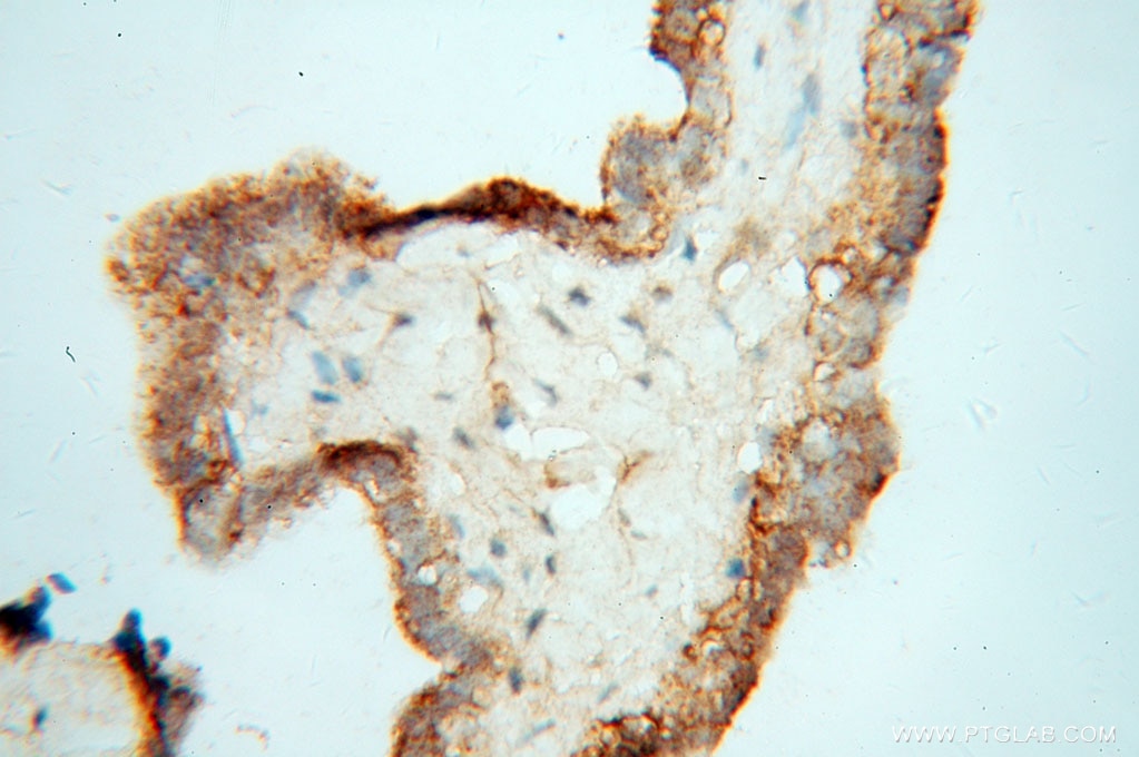 Immunohistochemistry (IHC) staining of human ovary tumor tissue using WDR18 Polyclonal antibody (15165-1-AP)
