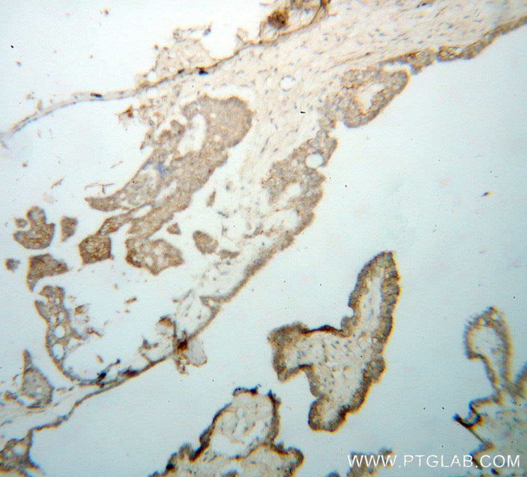 Immunohistochemistry (IHC) staining of human ovary tumor tissue using WDR18 Polyclonal antibody (15165-1-AP)