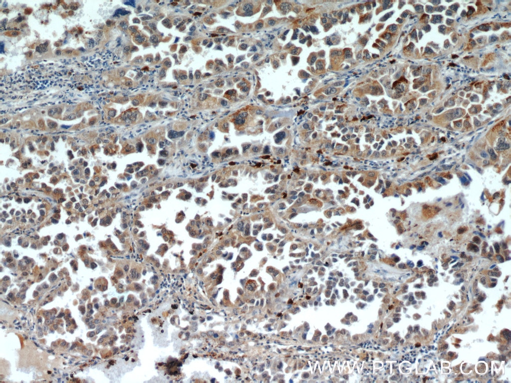 Immunohistochemistry (IHC) staining of human lung cancer tissue using WDR18 Polyclonal antibody (15165-1-AP)