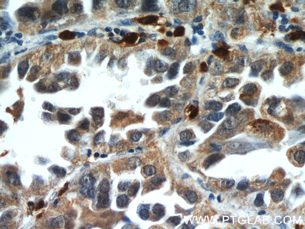 Immunohistochemistry (IHC) staining of human lung cancer tissue using WDR18 Polyclonal antibody (15165-1-AP)