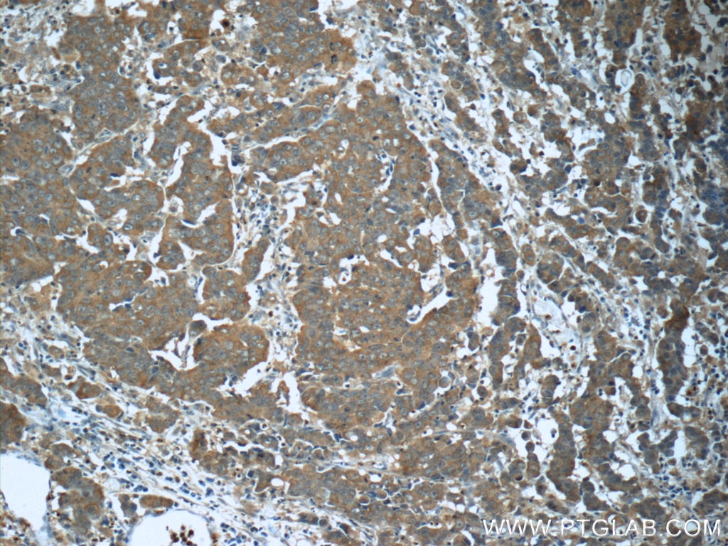 Immunohistochemistry (IHC) staining of human prostate cancer tissue using WDR19/IFT144 Polyclonal antibody (13647-1-AP)