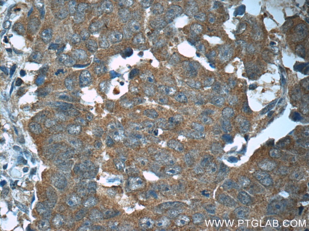 Immunohistochemistry (IHC) staining of human prostate cancer tissue using WDR19/IFT144 Polyclonal antibody (13647-1-AP)
