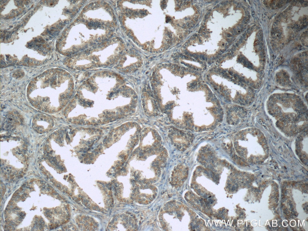 IHC staining of human prostate hyperplasia using 13647-1-AP