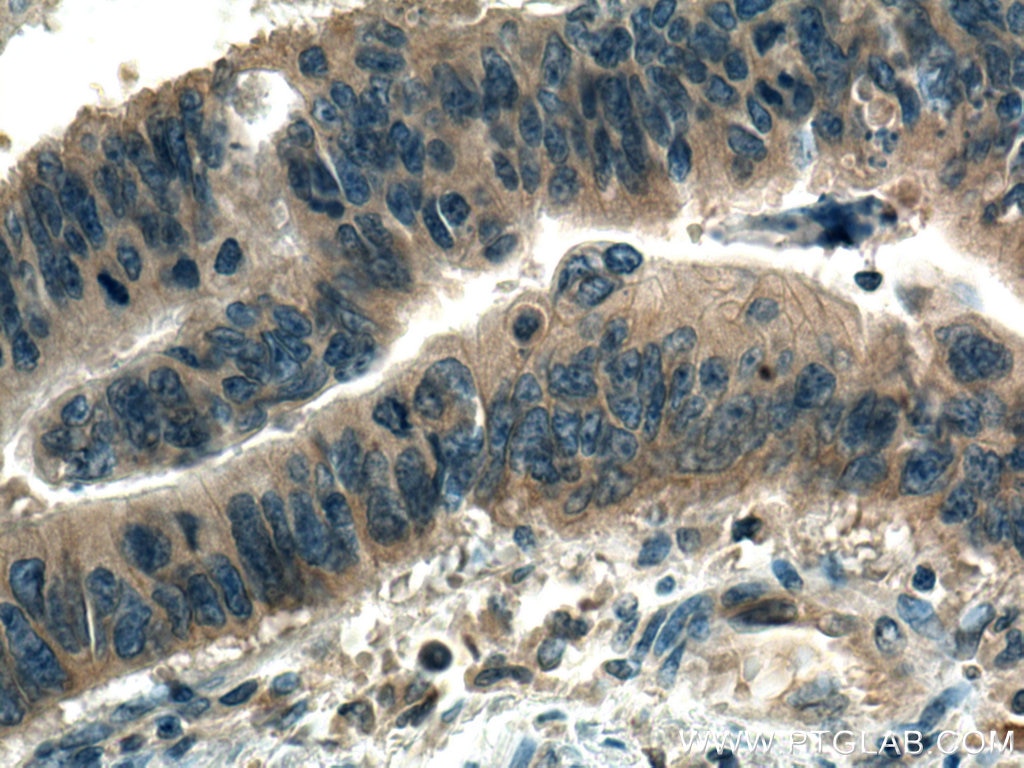 Immunohistochemistry (IHC) staining of human colon cancer tissue using WDR24 Polyclonal antibody (20778-1-AP)