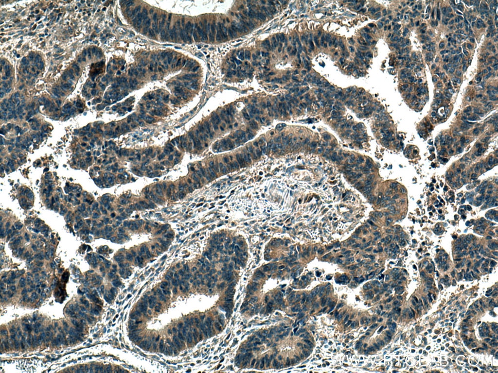 Immunohistochemistry (IHC) staining of human colon cancer tissue using WDR24 Polyclonal antibody (20778-1-AP)