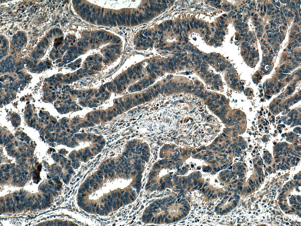 IHC staining of human colon cancer using 20778-1-AP