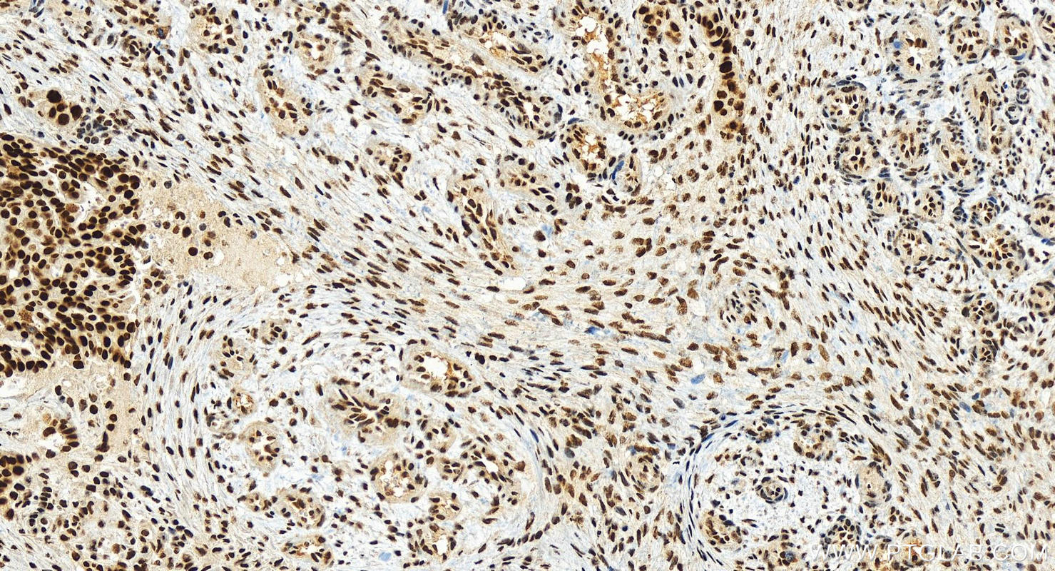 Immunohistochemistry (IHC) staining of human ovarian  cancer using WDR33 Polyclonal antibody (22614-1-AP)