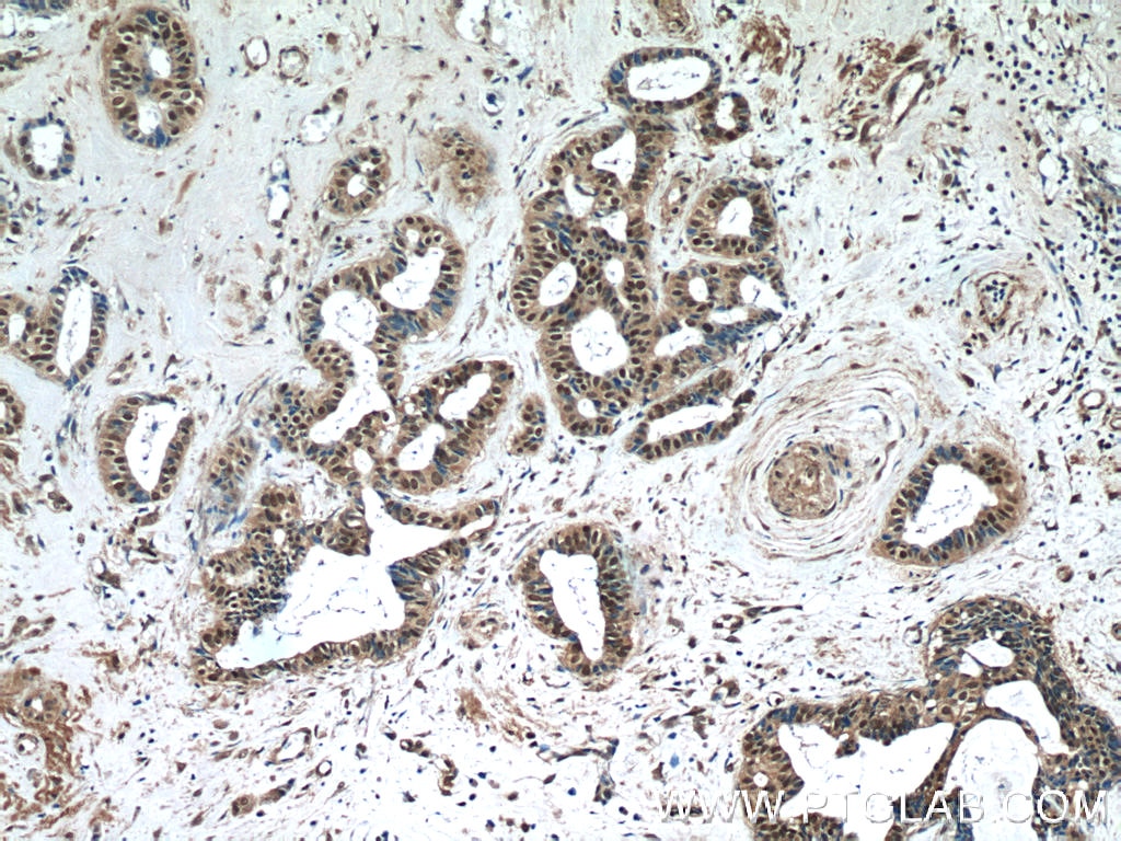 Immunohistochemistry (IHC) staining of human breast cancer tissue using WDR38 Polyclonal antibody (25683-1-AP)