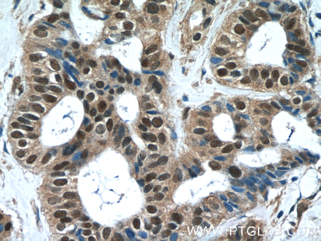 Immunohistochemistry (IHC) staining of human breast cancer tissue using WDR38 Polyclonal antibody (25683-1-AP)