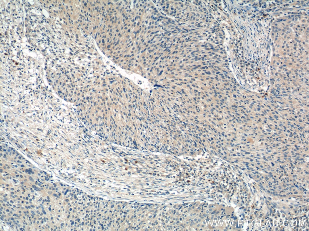 Immunohistochemistry (IHC) staining of human lung cancer tissue using WDR40A Polyclonal antibody (20478-1-AP)