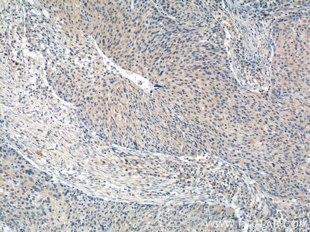 Immunohistochemistry (IHC) staining of human lung cancer tissue using WDR40A Polyclonal antibody (20478-1-AP)