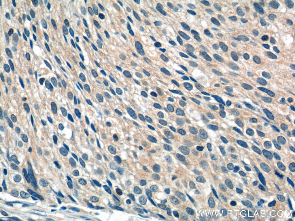 Immunohistochemistry (IHC) staining of human lung cancer tissue using WDR40A Polyclonal antibody (20478-1-AP)