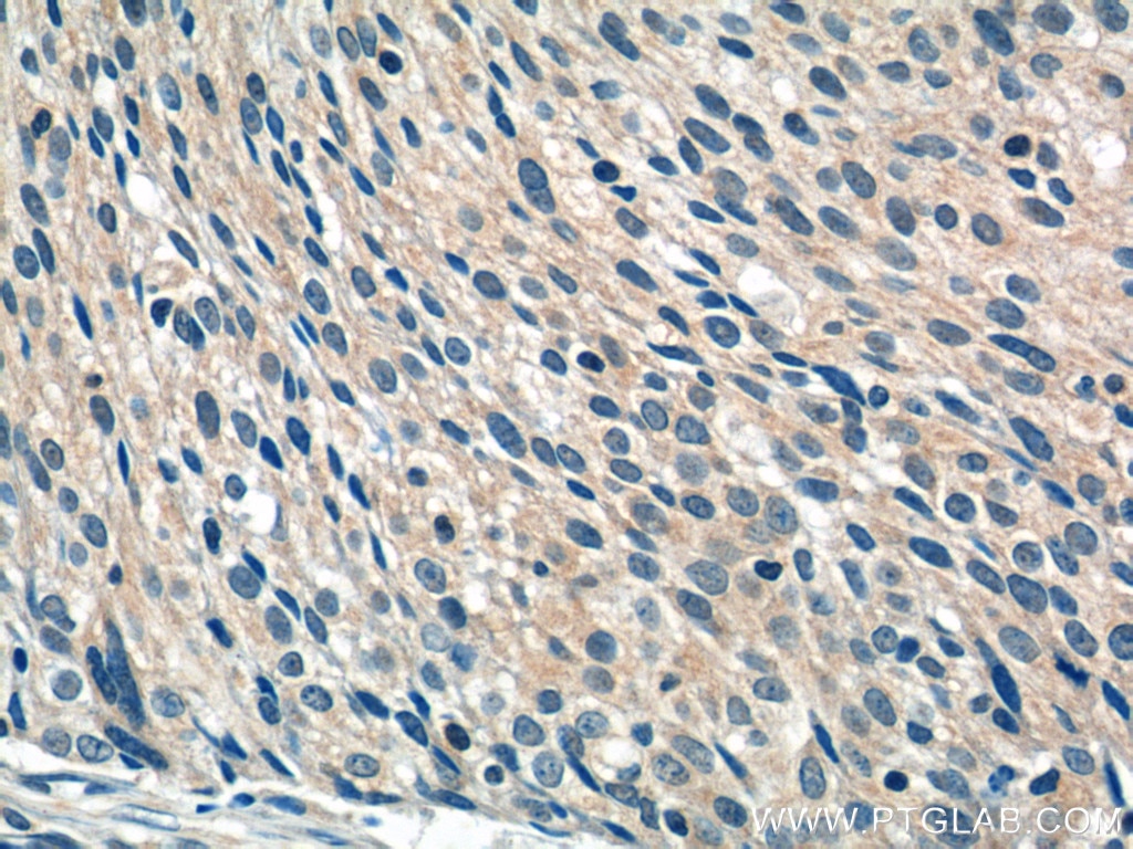 Immunohistochemistry (IHC) staining of human lung cancer tissue using WDR40A Polyclonal antibody (20478-1-AP)