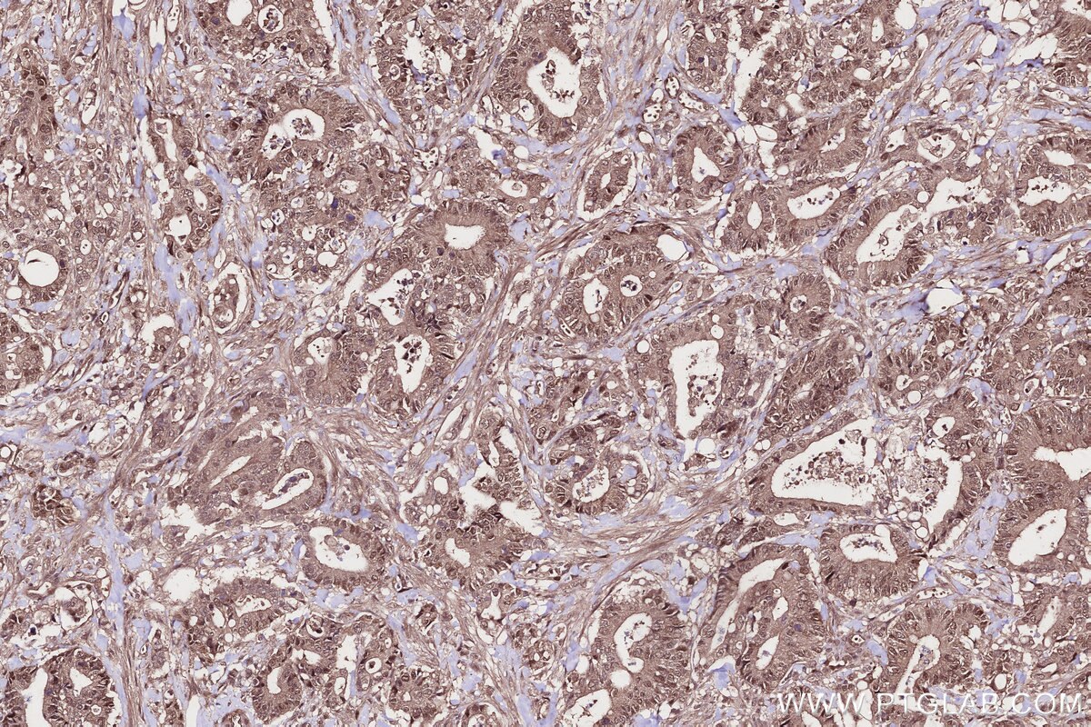 Immunohistochemistry (IHC) staining of human rectal cancer tissue using WDR48 Polyclonal antibody (16503-1-AP)
