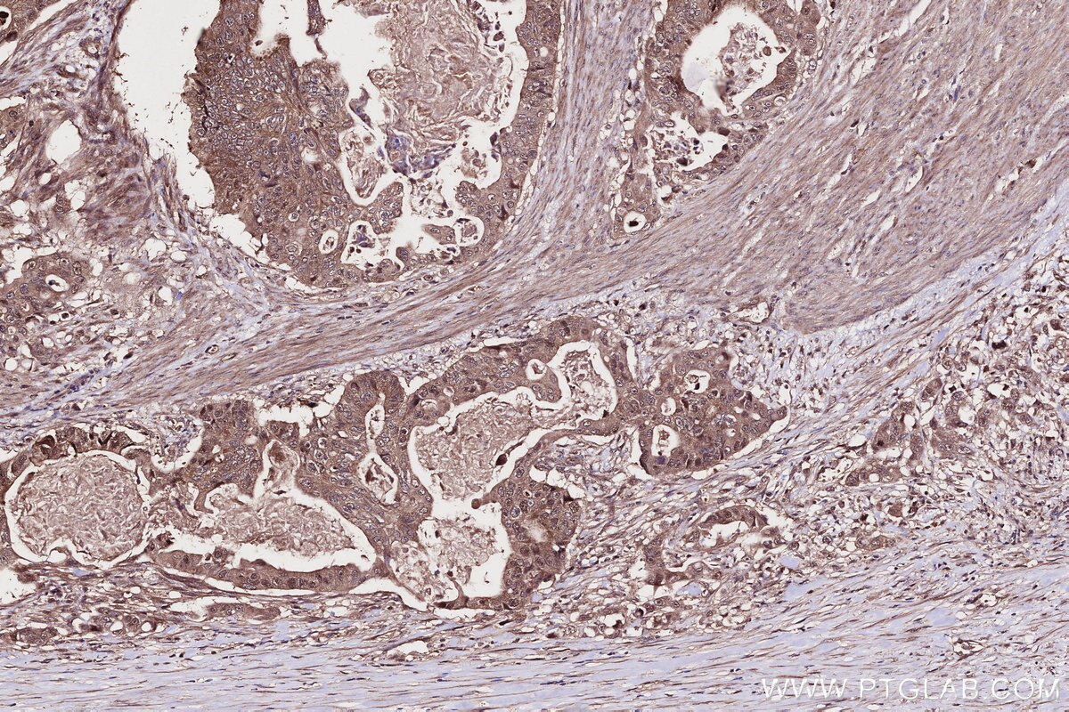 Immunohistochemistry (IHC) staining of human stomach cancer tissue using WDR48 Polyclonal antibody (16503-1-AP)