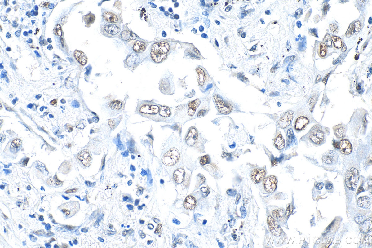 Immunohistochemistry (IHC) staining of human lung cancer tissue using WDR5 Polyclonal antibody (15544-1-AP)