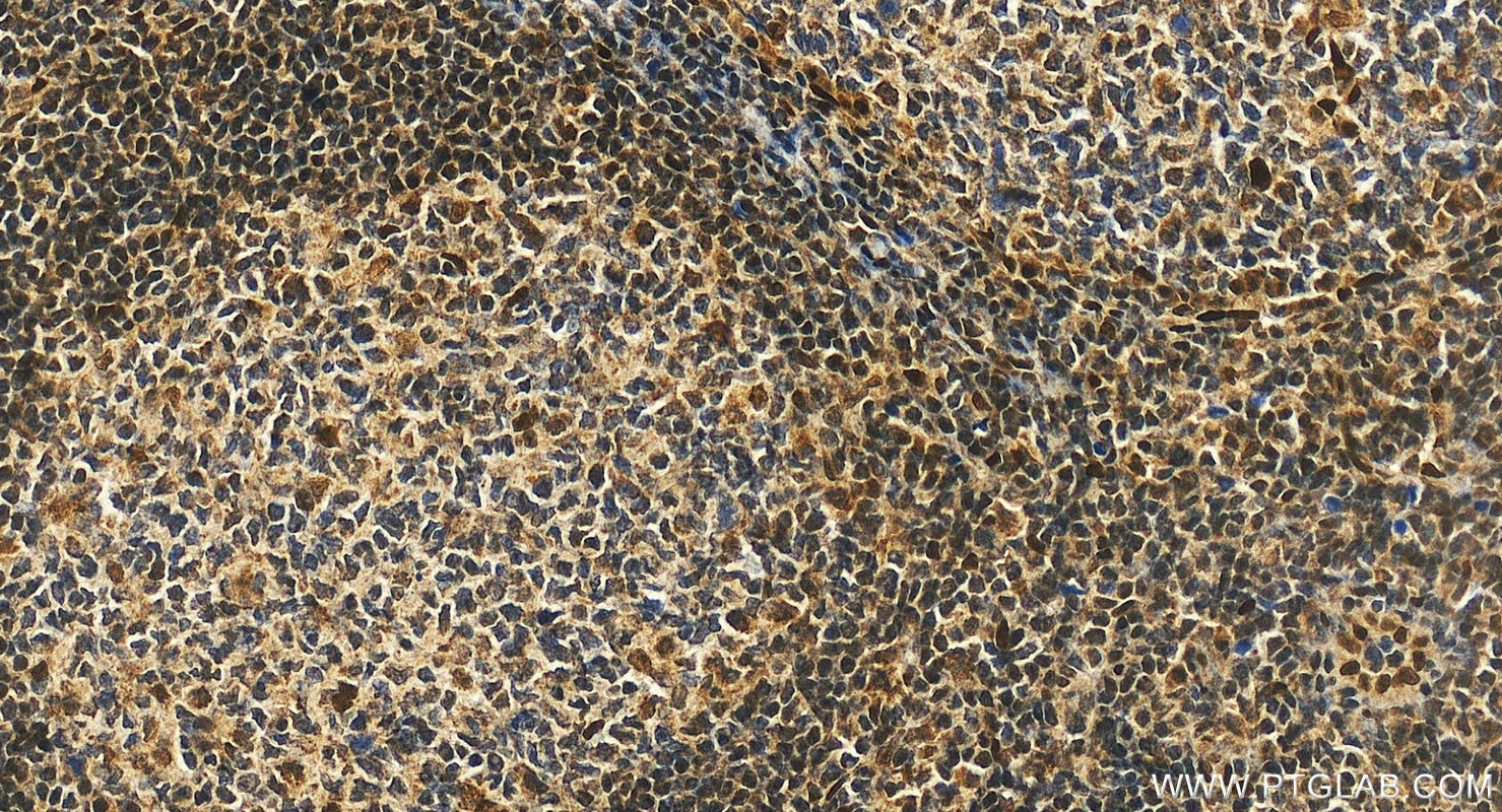 Immunohistochemistry (IHC) staining of human tonsillitis tissue using WDR5 Polyclonal antibody (15544-1-AP)