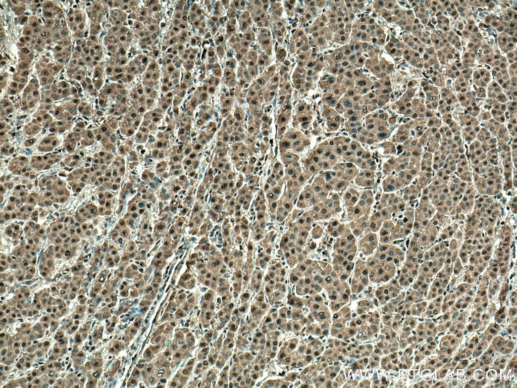 Immunohistochemistry (IHC) staining of human liver cancer tissue using WDR55 Polyclonal antibody (20786-1-AP)