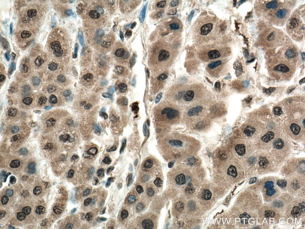 Immunohistochemistry (IHC) staining of human liver cancer tissue using WDR55 Polyclonal antibody (20786-1-AP)