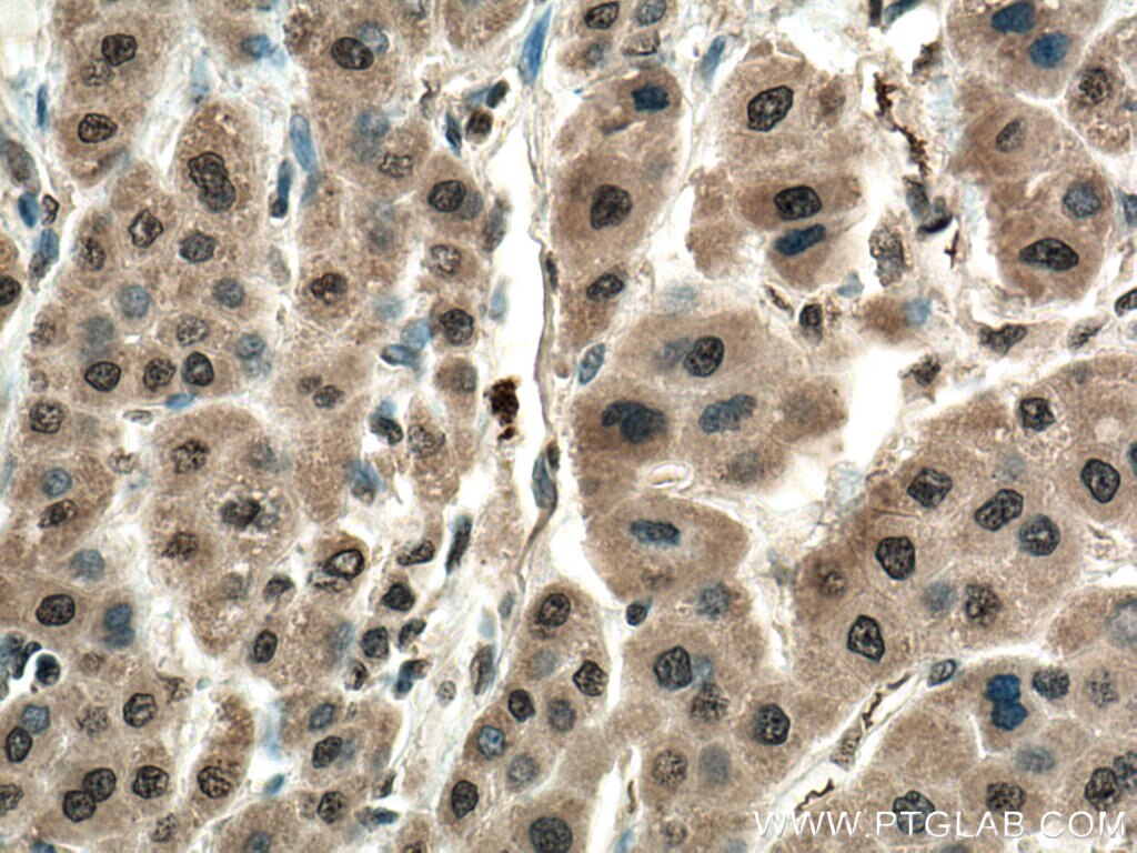 IHC staining of human liver cancer using 20786-1-AP