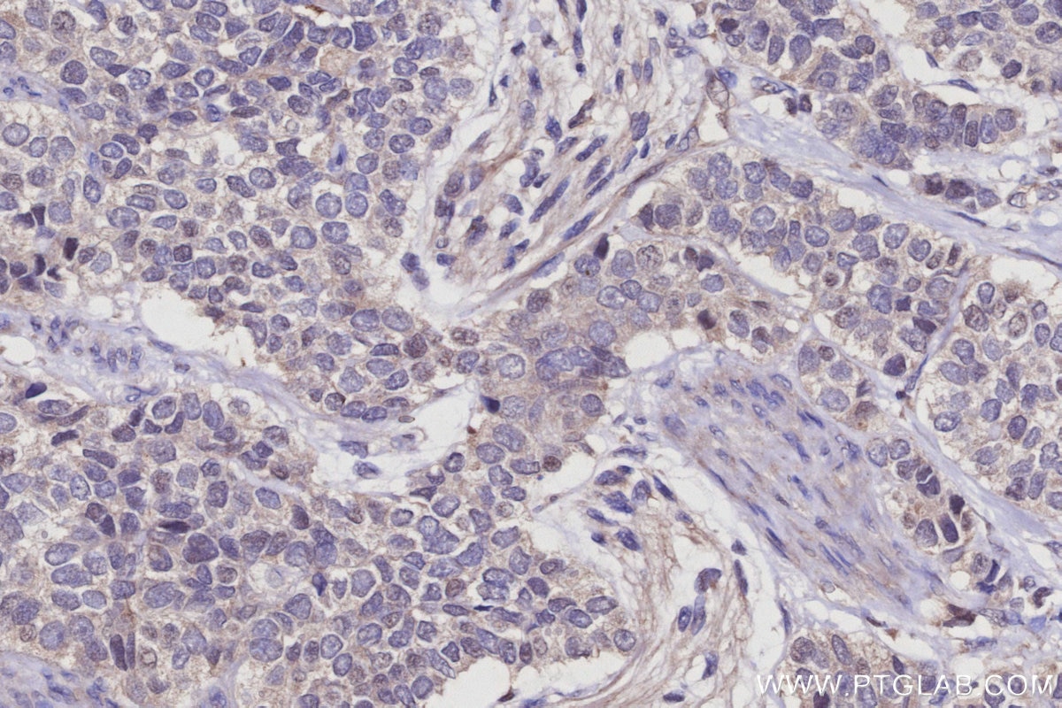 Immunohistochemistry (IHC) staining of human stomach cancer tissue using WDR6 Polyclonal antibody (20508-1-AP)