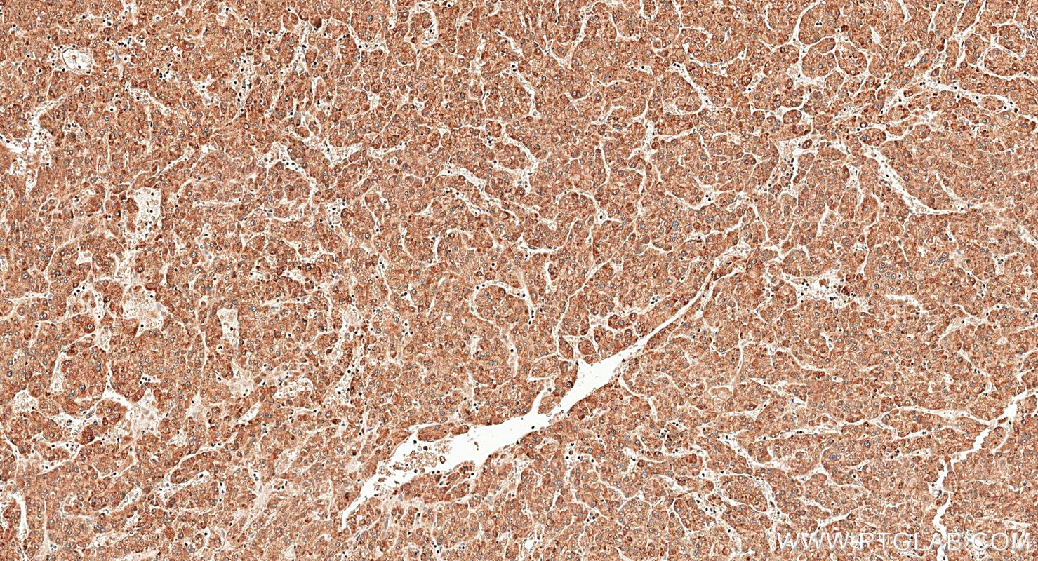 Immunohistochemistry (IHC) staining of human liver cancer tissue using WDR6 Polyclonal antibody (20508-1-AP)