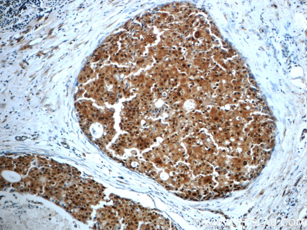 Immunohistochemistry (IHC) staining of human breast cancer tissue using WDR61 Polyclonal antibody (22536-1-AP)